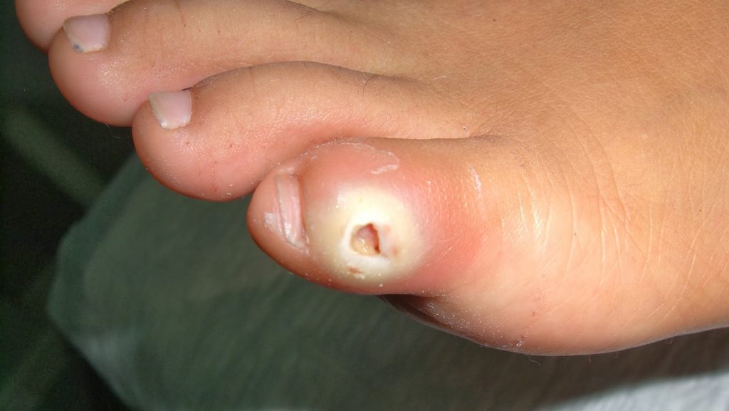 Maceración dorso dedo