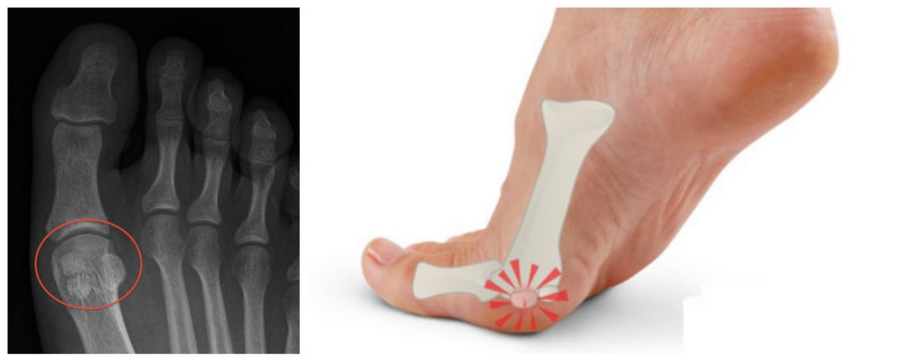 collage-sesamoiditis