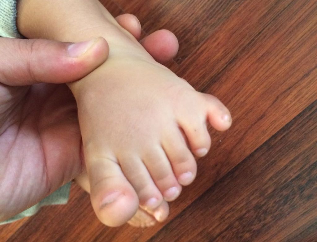 seis dedos en el pie