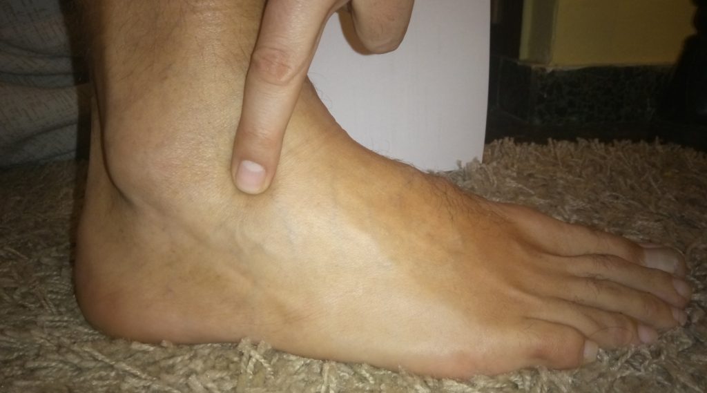 Síndrome del Seno del Tarso