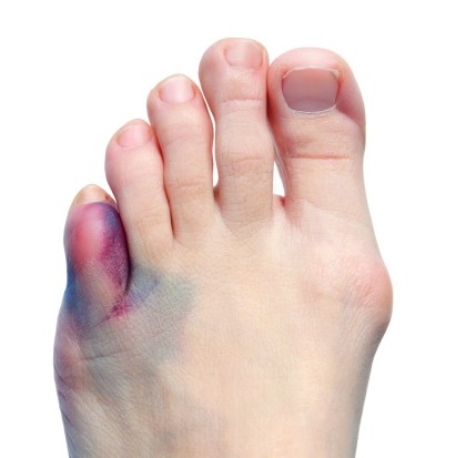 fractura-dedo-pequeno-pie